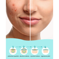 Náplasti na akné transparentní 180 ks